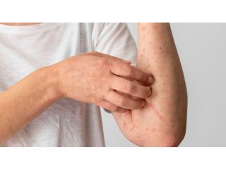 التهاب الجلد العصبي: الأسباب والأعراض وكيفية العلاج