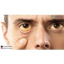 علامات الشفاء من اليرقان عند الكبار