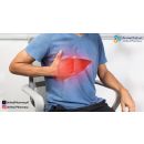 أعراض تليف الكبد المتقدم وطرق علاجه