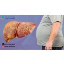  الأمراض التي تصيب الكبد وأعراضها لفهم طبيعة هذه المشكلات وأسبابها ومدى خطورتها