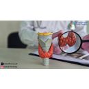 أعراض سرطان الغدد اللمفاوية تحت الفك