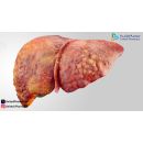 اعراض دهون الكبد وكيفية التخلص منها​