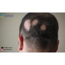 ما هي الثعلبة