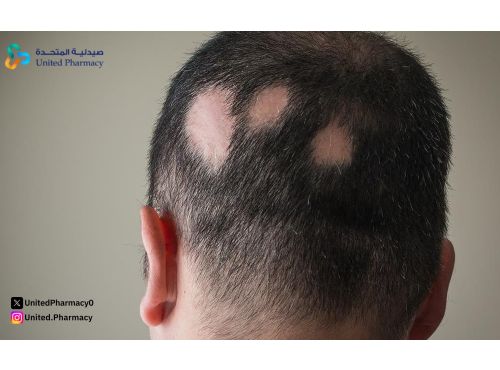 ما هي الثعلبة