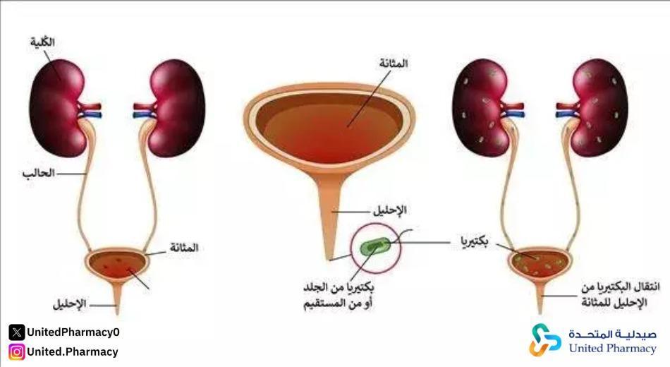 اعراض التهاب المثانة عند المراة