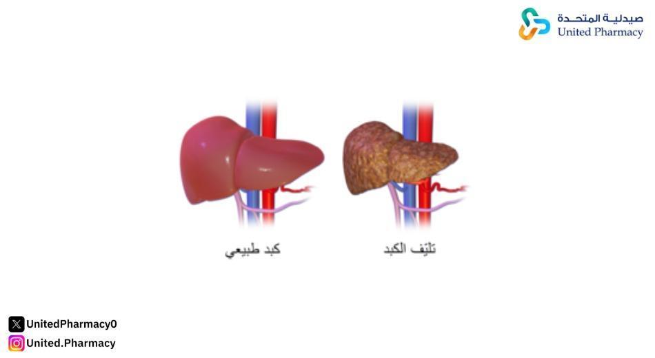 أعراض تليف الكبد