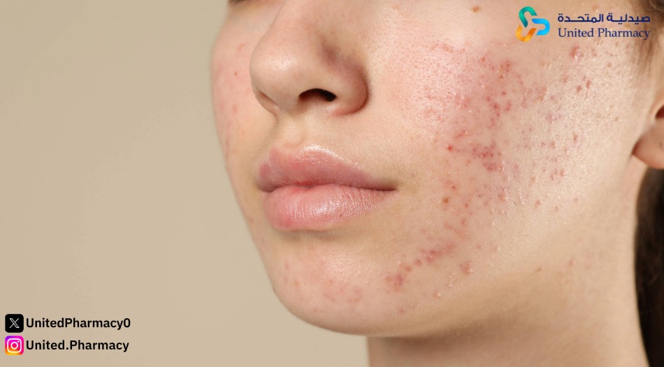 ما هي فوائد حبوب الروكتان للوجه؟