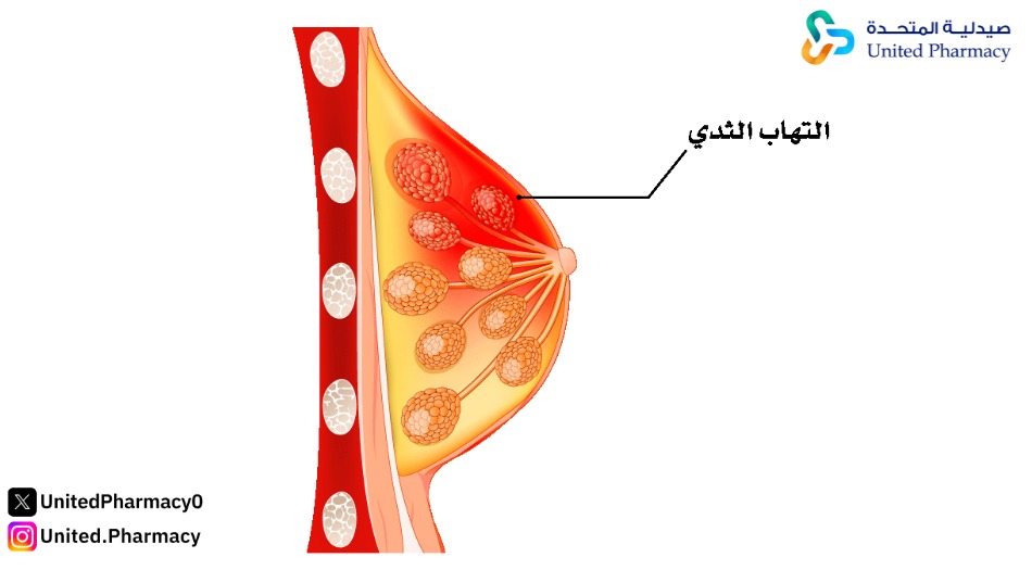 ما هي أسباب التهاب الثدي؟